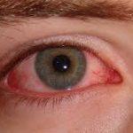 conjuctivitis, pink eye, eye, red eye