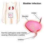urinary tract infection, bladder