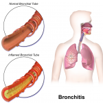Bronchitis, lung, cough, anatomy