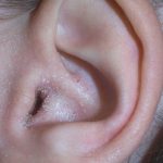 ear infection, ear