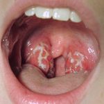 strep throat, sore throat, throat, infection - dofody
